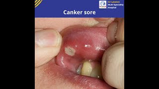 Canker sore   Know Symptoms and Causes of Canker sore   slmsh [upl. by Nanette]