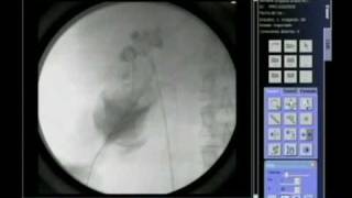 FLUOROSCOPY IN PERCUTANEUS RENAL SURGERY [upl. by Neumann]