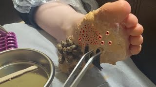 Removing TICKS and WORMS from the foot  trypophobia [upl. by Woodring]