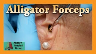 Alligator Forceps Ear Wax Removal  Auburn Medical Group [upl. by Steele179]