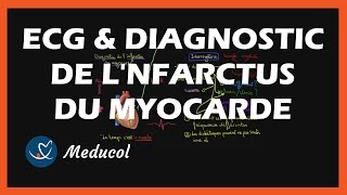 ECG et diagnostic de linfarctus du myocarde crise cardiaque [upl. by Rivalee]