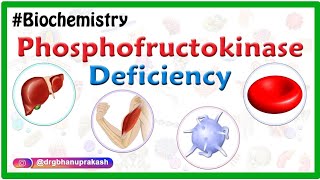 Phosphofructokinase deficiency Animation Tarui disease  GlycogenStorage Disease Type VII  USMLE [upl. by Guss]