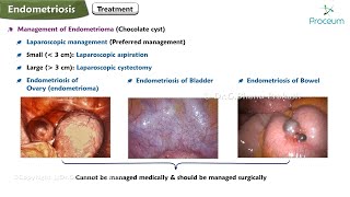 Endometriosis Etiology Pathology Clinical features Investigations Treatment [upl. by Nedloh]