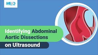 Identifying Abdominal Aortic Dissections on Ultrasound [upl. by Bandeen470]