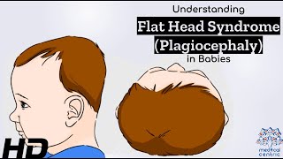 Flat Head Syndrome Explained Causes Symptoms and Solutions [upl. by Twyla]