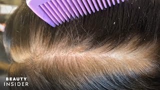 How Severe Dandruff Is Removed From The Scalp  Insider Beauty [upl. by Bathsheb]