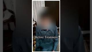 SLP Dr Nasir Khan Puberphonia treatment in Pakistan Prepost By voice therapy without pain [upl. by Shiff]