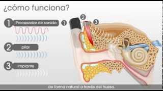 SH Medical Group  Como funciona el sistema auditivo Cochlear Baha [upl. by Nevetse18]