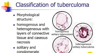 Secondary tuberculosis Focal tuberculosis Tuberculoma Infiltrative tuberculosis [upl. by Wendye250]