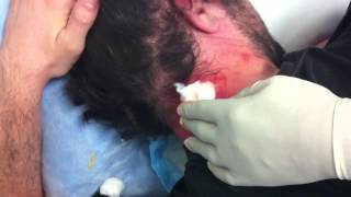 DJC007 Exploding Cyst [upl. by Madden]