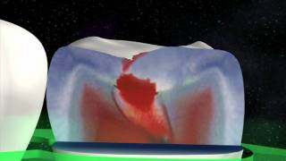 KaVo DIAGNOdent pen Find hidden caries [upl. by Mccallum]