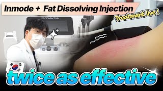 InMode  Fat dissolving Injection popular in Korea  procedure LIVE [upl. by Adaval]