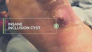 INSANE INCLUSION CYST [upl. by Laleb]