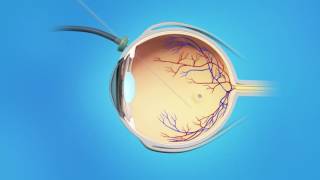 Epiretinal Membrane Peeling  Keep Calm and Rescue On [upl. by Setarcos]