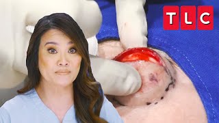 Dr Lee Squeezes “Devil Horn” Cyst off the Forehead of a Patient  Dr Pimple Popper  TLC [upl. by Uuge]