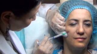 Fluid Facelift  with RADIESSE Dermal filler Demonstrated by Dr Nancy Labib [upl. by Llenel]