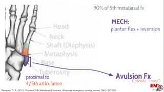 5th Metatarsal Fractures [upl. by Kcirej]