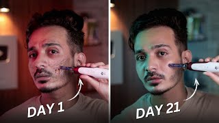 My Scar’s Journey with Dermapen at Home [upl. by Miahc732]