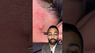 Ingrown Hair Extraction  Dr Somji Reacts [upl. by Gnirps799]