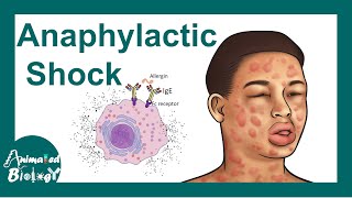 Anaphylactic shock  Anaphylactic Reaction Symptoms and Treatment [upl. by Nata]