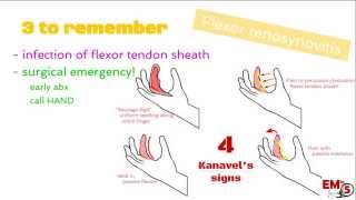 Flexor Tenosynovitis [upl. by Wendolyn450]