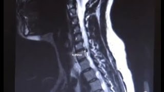 Cervical Spine Fusion with Neurosurgeon Dr Alok Chaudhari [upl. by Ylram]