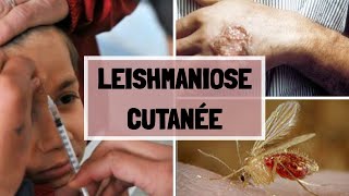 LA LEISHMANIOSE CUTANNÉ  CAUSES  SYPMTOMES  COMPLICATIONS  TRAITEMENT [upl. by Sullecram]