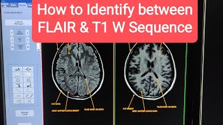 FLAIR vs T1 weighted MRI images  how to tell the difference [upl. by Assili258]