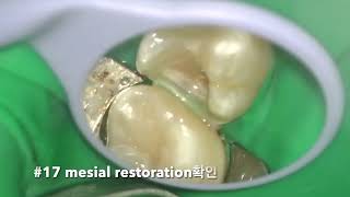 26 partial pulpectomy amp 27 proximal occlusal resin restoration [upl. by Heinrich]