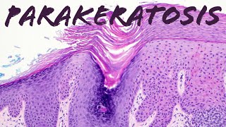 What is Parakeratosis amp Why does it happen Actinic keratosis vs Lichen simplex chronicus [upl. by Sudnor]