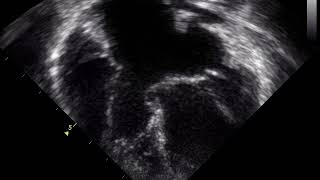 Defeito do Septo Atrioventricular DSAV [upl. by Iene]