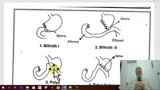 Gastric surgery 17  Complications of Gastric operations  by Dr Wahdan [upl. by Dagna]