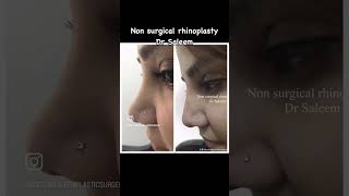 Non surgical rhinoplasty in lahore Pakistan with fillers by dr Saleem nonsurgicalnosejob [upl. by Abelard274]