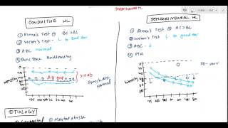 Conductive and Sensorineural Hearing Loss Deafness for USMLE [upl. by Ayikaz]