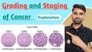 Grading And Staging of Cancer in Hindi  Grading And Staging of Cancer Lecture in Hindi [upl. by Itsirhc]