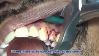 Physics forcep extraction Periapically infected upper molar [upl. by Acinemod]