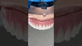 Metal Mesh Denture with a Hybrid Bar lsk121shorts dentistteeth [upl. by Esej311]