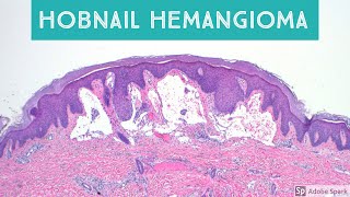 Hobnail Hemangioma Targetoid Hemosiderotic Hemangioma Retiform Hemangioendothelioma and Mimics [upl. by Tadio128]