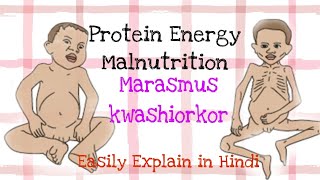 Marasmus and kwashiorkor Easy explanation in Hindi biomedical mbbs nursing [upl. by Mckenna499]