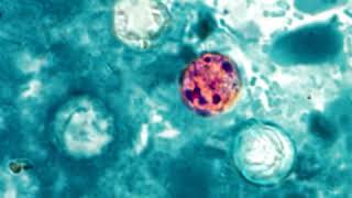 Cyclosporiasis  Wikipedia audio article [upl. by Meli]