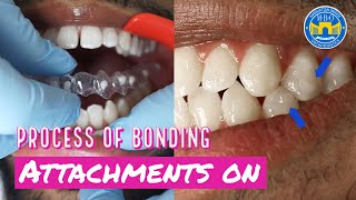 Orthodontics Treatment for Overjet Overbite  Headgear vs Forsus Appliance [upl. by Kotto]