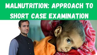 Approach to short case of Malnutrition  Malnutrition in Paediatrics Malnutrition case presentation [upl. by Yelkcub]