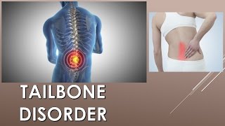 What does it mean when your tailbone hurts Treatment of Tailbone Disorder [upl. by Bucher]