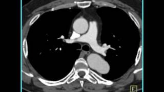 4D Imaging of the Aortic Valve Repaired coarctation of the aorta 3 of 3 [upl. by Htes247]