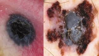 Difficult to recognize variants of melanoma  Dr R Pampena [upl. by Parshall]