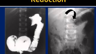 Intussusception Reduction HowTo [upl. by Nageet22]