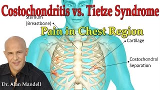 Costochondritis vs Tietzes Syndrome Pain in Chest Region  Dr Mandell [upl. by Foster643]