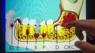 Tratamento cirúrgico dos cistos odontogênicos [upl. by Ehling]