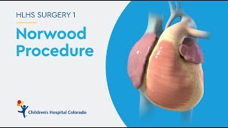 What is the Norwood Procedure for Hypoplastic Left Heart Syndrome [upl. by Yddeg575]