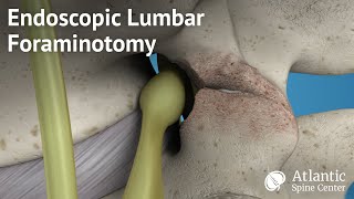 Endoscopic Lumbar Foraminotomy [upl. by Anhej]